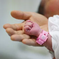「血管腫の除去は必要ですか?」血管腫の原因、治療、症状について徹底解説
