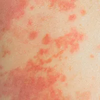 海外旅行後に発熱と赤い斑点?「麻疹」の症状から予防接種、治療法まで