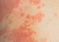 海外旅行後に発熱と赤い斑点?「麻疹」の症状から予防接種、治療法まで