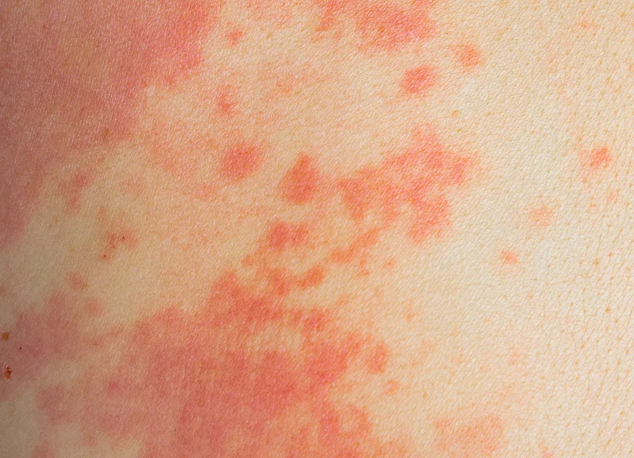 海外旅行後に発熱と赤い斑点?「麻疹」の症状から予防接種、治療法まで