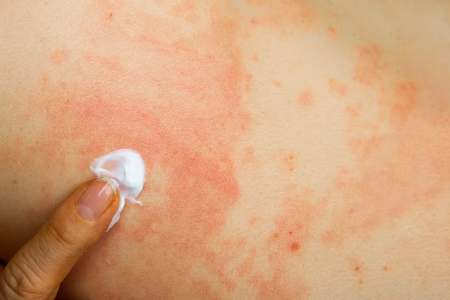 薔薇色粃糠疹の治療