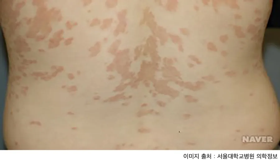 薔薇色粃糠疹の原因