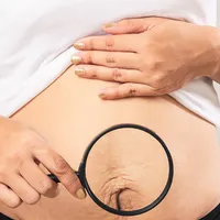 気になる「妊娠線(肉割れ)」消す方法は?原因や、予防法、除去方法まとめ