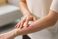 急な筋肉痛は帯状疱疹の前兆かも?帯状疱疹の症状と治療法