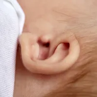 耳の中にできる腫瘍「真珠腫」の症状、原因、診断、治療法について