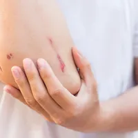 転倒して擦りむいた「擦過傷」の治療、傷跡、応急処置法について解説