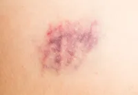 特にぶつけた訳でもないのに、足にあざができる?『血管炎』の症状と検査、治療法