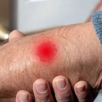 致命的な感染症『炭疽病』の症状と原因、治療法は?