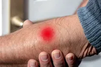 致命的な感染症『炭疽病』の症状と原因、治療法は?