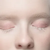 真っ白な肌と髪『アルビノ(白子症)』の原因と症状、白斑症との違いは?