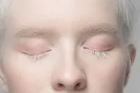 真っ白な肌と髪『アルビノ(白子症)』の原因と症状、白斑症との違いは?