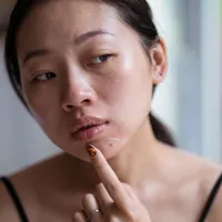 「アダパレン、本当に効果ありますか?」ニキビ治療薬アダパレンの効果、副作用、注意事項