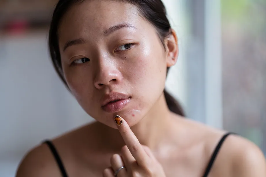 「アダパレン、本当に効果ありますか?」ニキビ治療薬アダパレンの効果、副作用、注意事項