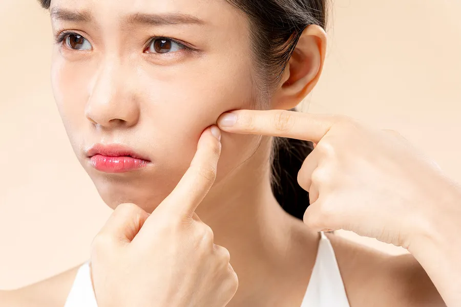 ディフェリン使用方法