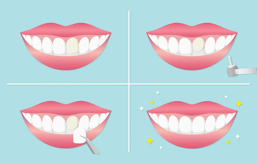 ラミネートのおすすめ