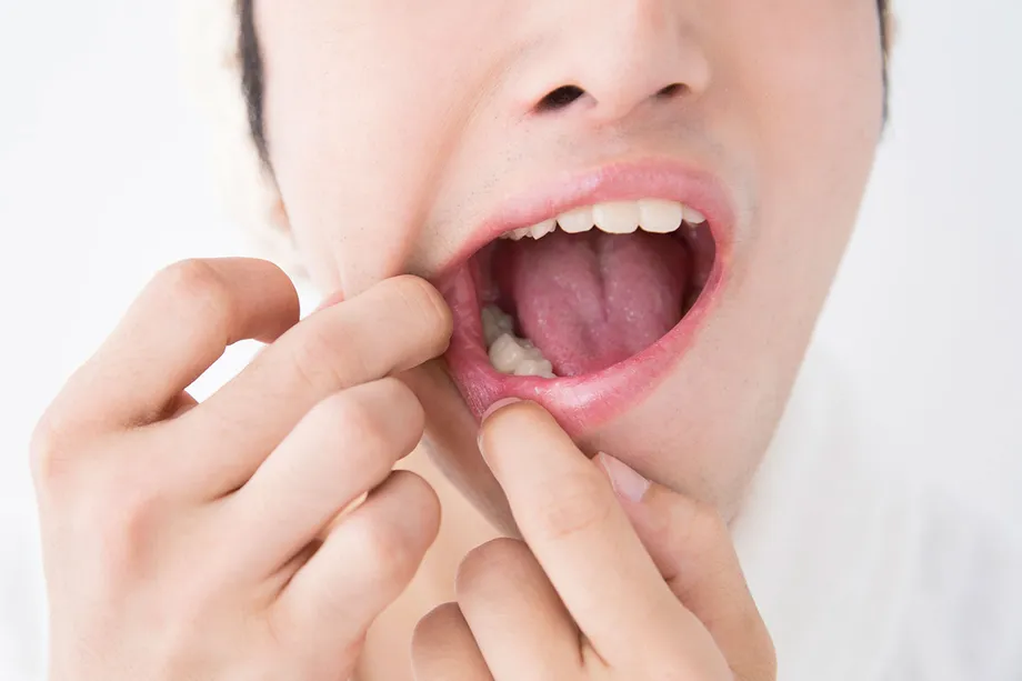 口内炎を早く治す方法。口内炎がよくできる人必見!