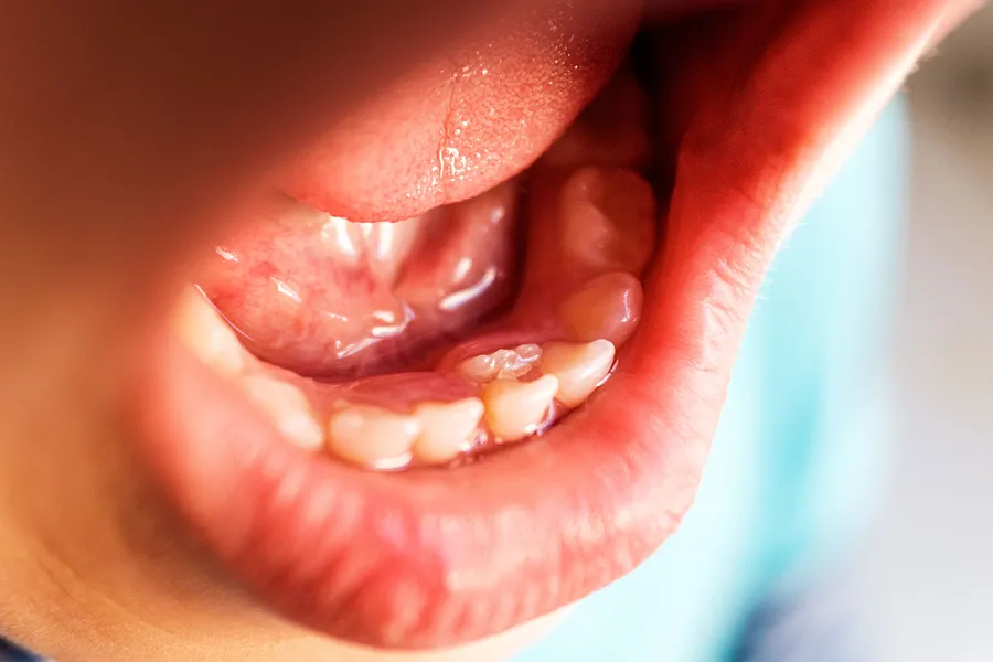 口内炎の種類
