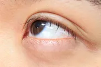 [1分FAQ] 目のものもらいは他の人に感染しますか？