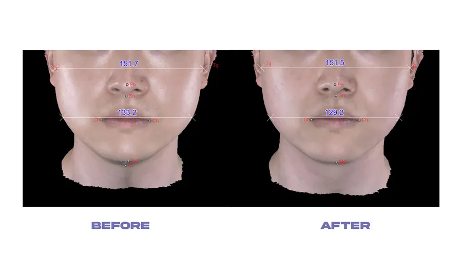 チタニウムリフティングの痛み