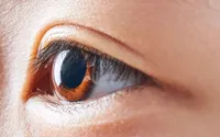 目の白目に水疱ができる『結膜浮腫』、結膜浮腫の症状や原因、対処法について