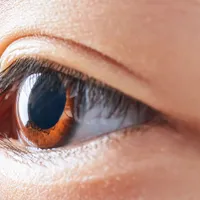 目の白目に水疱ができる『結膜浮腫』、結膜浮腫の症状や原因、対処法について