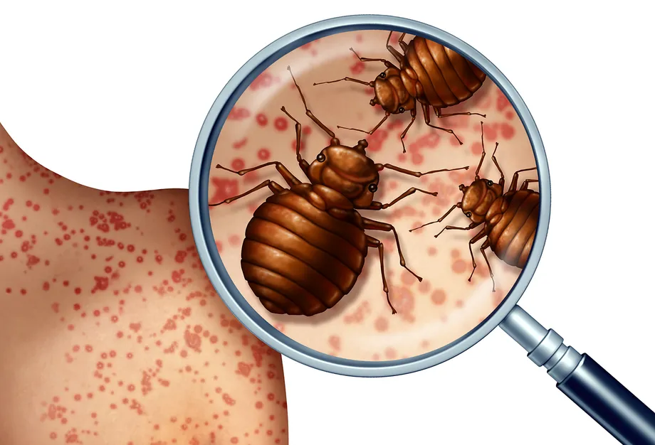 「トコジラミ(南京虫)にかまれたときの対処法は?」症状や対処法、予防法を解説します