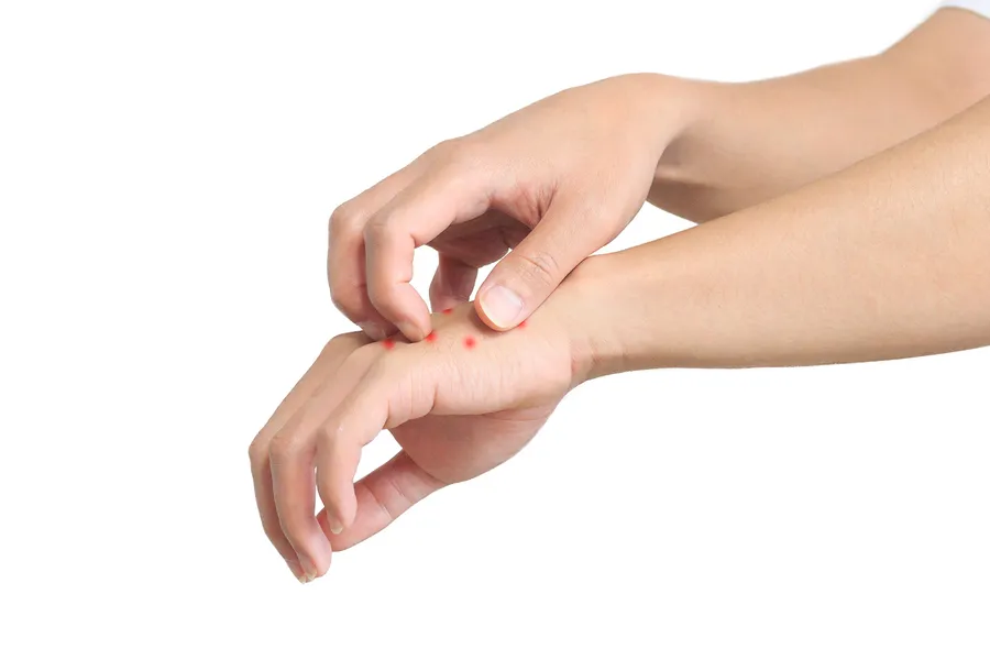 빈대 물리면 증상