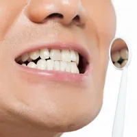 開咬の矯正、必要でしょうか? 開咬の原因や治療法について