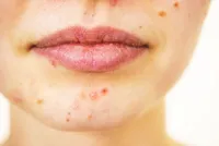 ニキビを消す方法?ニキビの治療方法や原因などまとめました