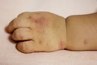 「手足口病の原因は?」幼児の手足口病の症状と原因、感染、予防、治療法まとめ