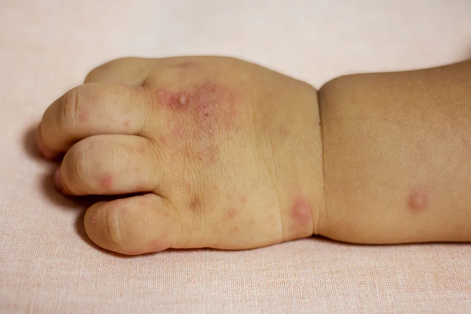 「手足口病の原因は?」幼児の手足口病の症状と原因、感染、予防、治療法まとめ