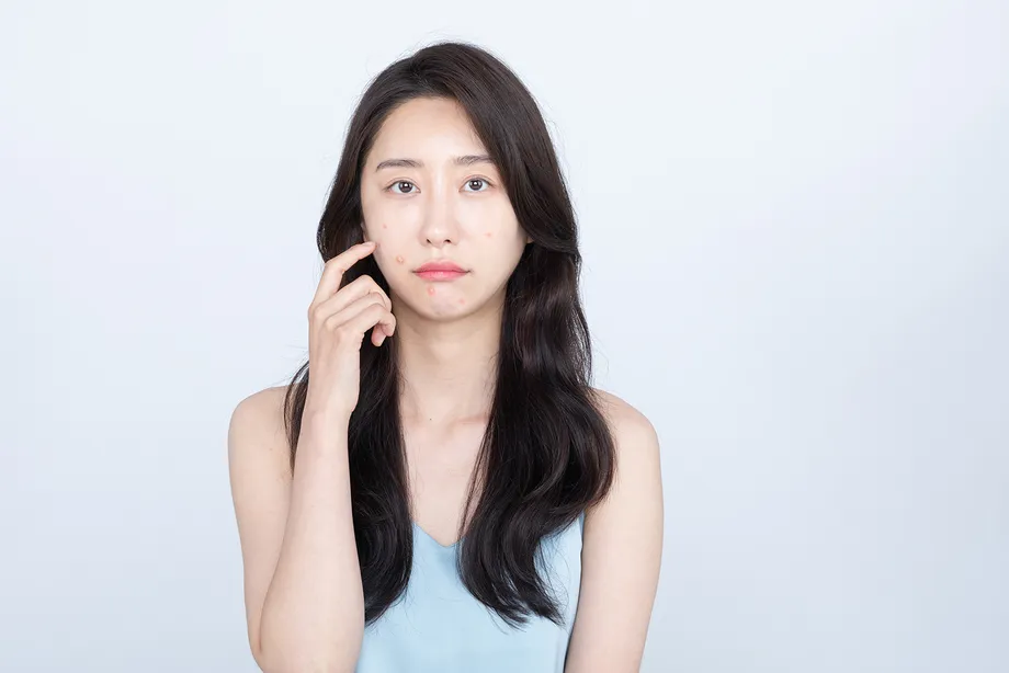 イソトレチノイン系のニキビ治療薬を処方してもらう方法