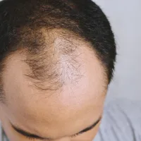 脱毛薬の薬はどこで買えるの?