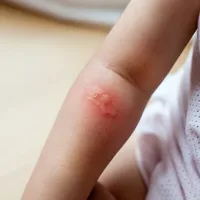 乳児の皮膚発疹の種類と症状および治療法を見てみましょう