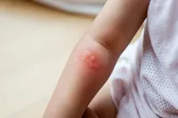 乳児の皮膚発疹の種類と症状および治療法を見てみましょう