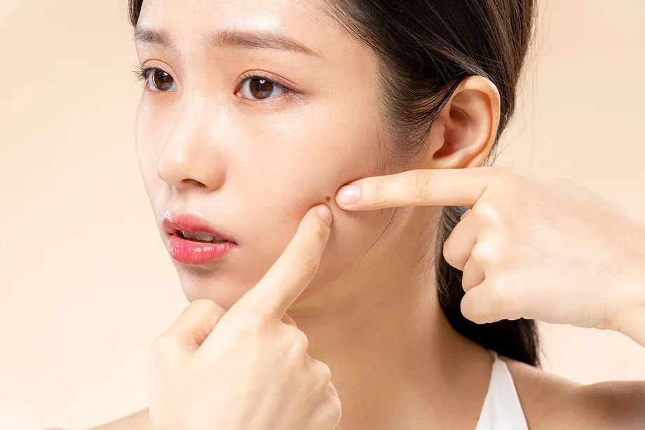 「イソトレチノインの副作用はひどい?」イソトレチノインの効果、服用方法や副作用までまとめて解説