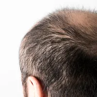 AGA薬のオンライン処方の方法