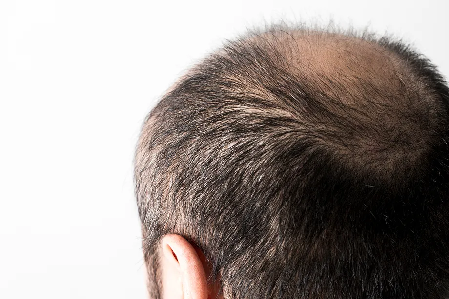 AGA薬のオンライン処方の方法