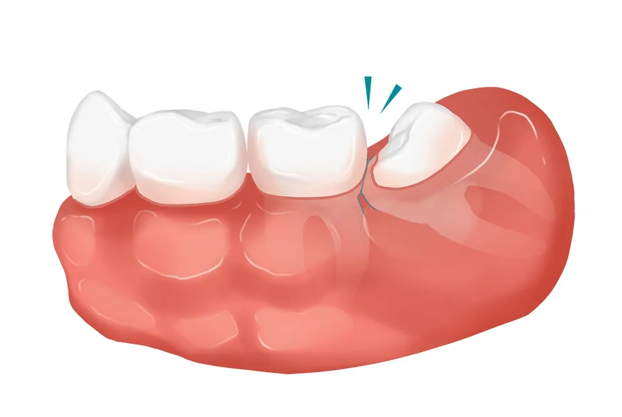 親知らずの抜歯