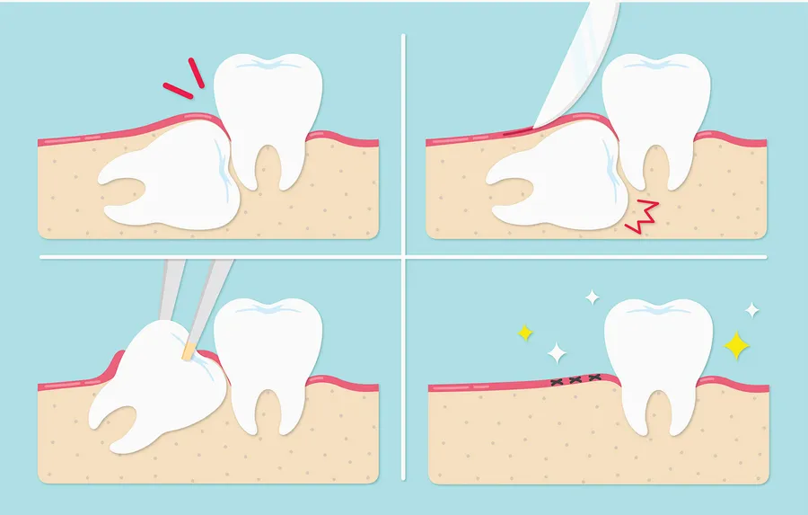 親知らずの抜歯注意事項